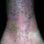 79. Stasis Dermatitis Pictures