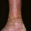 92. Stasis Dermatitis Pictures
