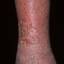 117. Stasis Dermatitis on Legs Pictures
