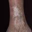 128. Stasis Dermatitis on Legs Pictures