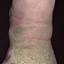 131. Stasis Dermatitis on Legs Pictures