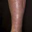 143. Stasis Dermatitis on Legs Pictures