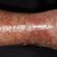 166. Stasis Dermatitis on Legs Pictures