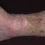 171. Stasis Dermatitis on Legs Pictures