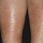 33. Stasis Dermatitis on Legs Pictures
