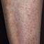 56. Stasis Dermatitis on Legs Pictures