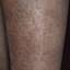 57. Stasis Dermatitis on Legs Pictures