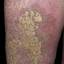 62. Stasis Dermatitis on Legs Pictures