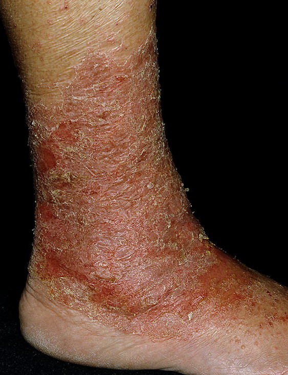 Stasis Dermatitis On Legs Pictures 174 Photos Images Illnessee