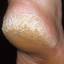 1. Hyperkeratosis Foot Pictures