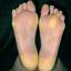 3. Hyperkeratosis Foot Pictures