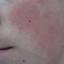 1. Hyperkeratosis on Face Pictures