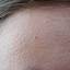 3. Hyperkeratosis on Face Pictures