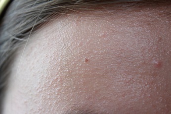 Hyperkeratosis on Face Pictures – 3 Photos & Images / illnessee.com