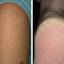 2. Hyperkeratosis Skin Pictures