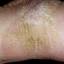 6. Hyperkeratosis Skin Pictures