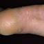 8. Hyperkeratosis Skin Pictures