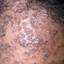 4. Hyperkeratosis on Head Pictures