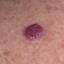 10. Hemangioma in Adults Pictures