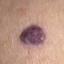 12. Hemangioma in Adults Pictures