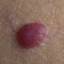 2. Hemangioma in Adults Pictures