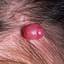 34. Hemangioma in Adults Pictures