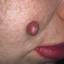 36. Hemangioma in Adults Pictures