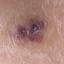 41. Hemangioma in Adults Pictures