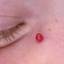52. Hemangioma in Adults Pictures