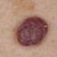 53. Hemangioma in Adults Pictures