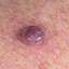 8. Hemangioma in Adults Pictures