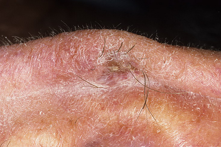 Hemangioma in Adults Pictures - 62 Photos & Images ...