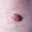 104. Molluscum Contagiosum Early Stages Pictures