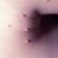 107. Molluscum Contagiosum Early Stages Pictures