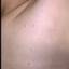 11. Molluscum Contagiosum Early Stages Pictures