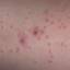 12. Molluscum Contagiosum Early Stages Pictures