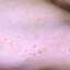 13. Molluscum Contagiosum Early Stages Pictures