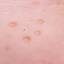 19. Molluscum Contagiosum Early Stages Pictures