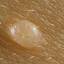 21. Molluscum Contagiosum Early Stages Pictures
