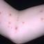 25. Molluscum Contagiosum Early Stages Pictures