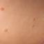 27. Molluscum Contagiosum Early Stages Pictures
