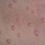 29. Molluscum Contagiosum Early Stages Pictures