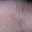 34. Molluscum Contagiosum Early Stages Pictures