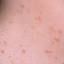 37. Molluscum Contagiosum Early Stages Pictures