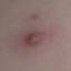 43. Molluscum Contagiosum Early Stages Pictures