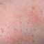 45. Molluscum Contagiosum Early Stages Pictures