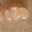 48. Molluscum Contagiosum Early Stages Pictures