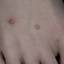 49. Molluscum Contagiosum Early Stages Pictures