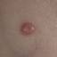 50. Molluscum Contagiosum Early Stages Pictures