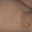 53. Molluscum Contagiosum Early Stages Pictures